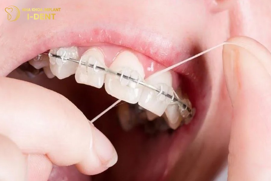 Tam-chi-nha-khoa-va-nuoc-suc-mieng-chuyen-dung-cho-nieng-rang