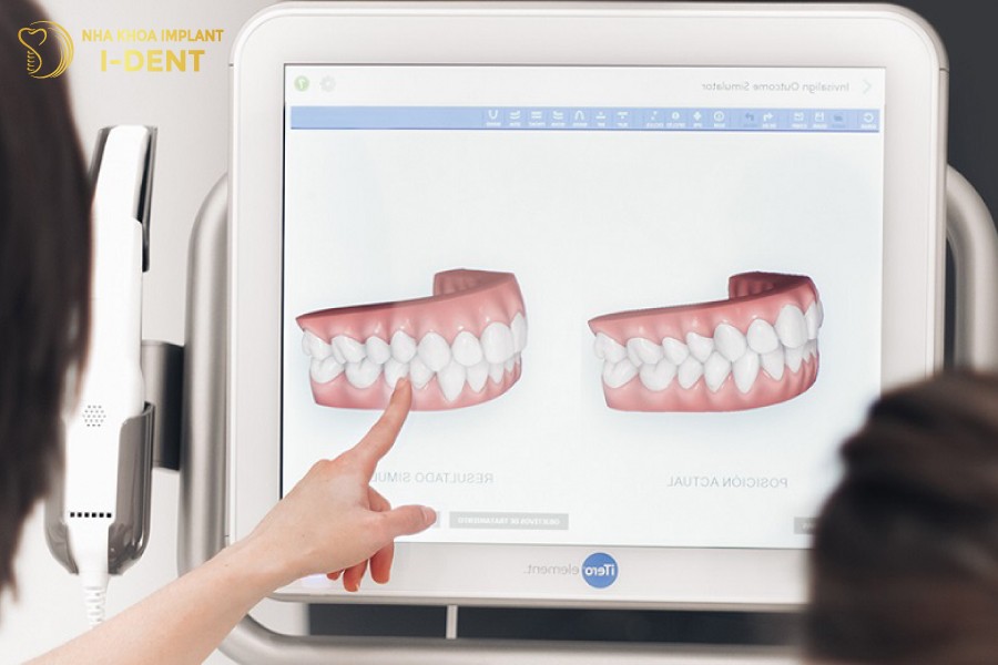 Thao-luan-voi-bac-si-truoc-khi-thuc-hien-nieng-rang-vau