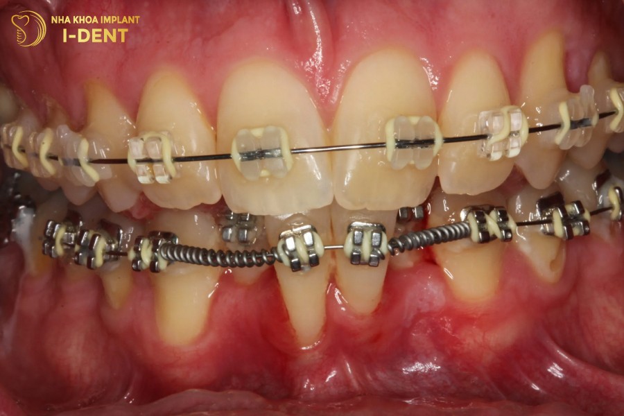 niềng răng lệch