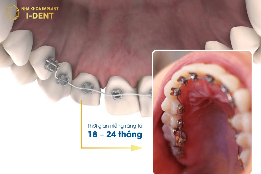 Thoi-gian-nieng-rang-tu-18-24-thang