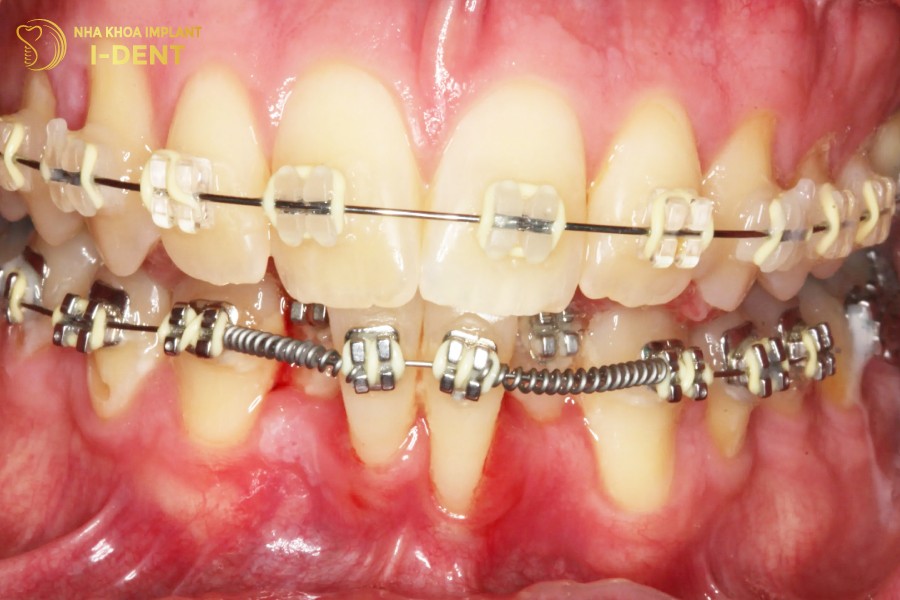 Tieu-xuong-khi-nieng-rang