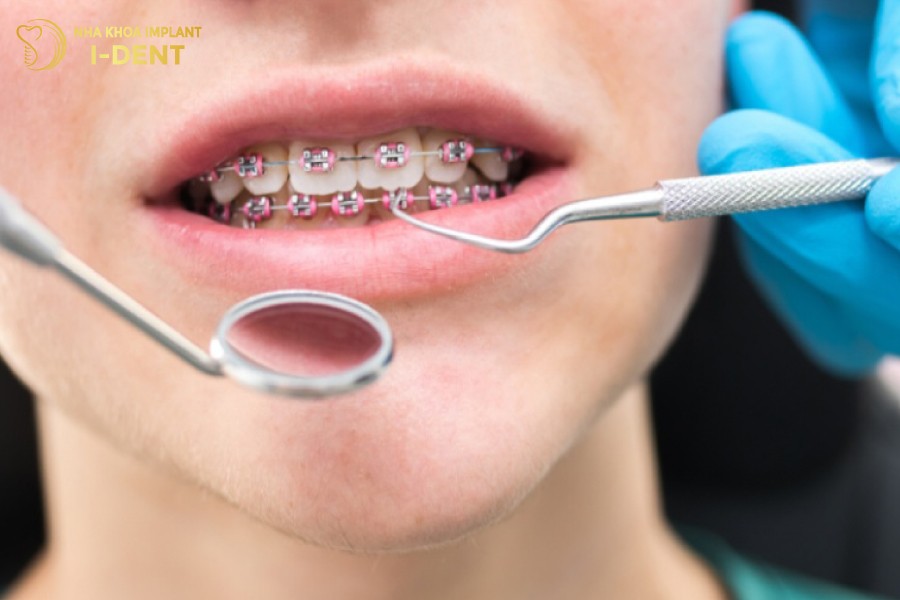 Tuổi 30 vẫn có thể niềng răng nhưng thời gian sẽ kéo dài hơn và kết quả không tối ưu như ở độ tuổi dưới 18