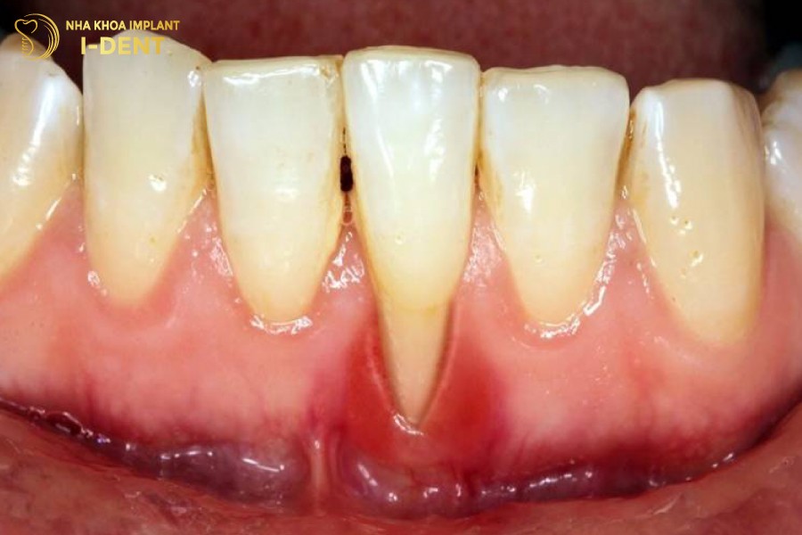 Viem-loi-tien-trien-thanh-viem-nha-chu-lam-rang-lung-lay-de-gay-