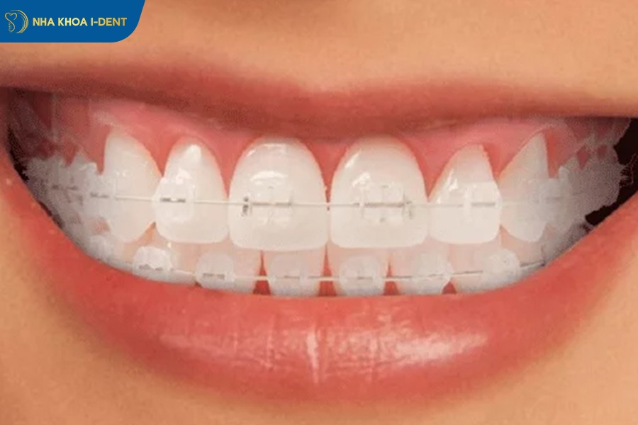 giá niềng răng khớp cắn ngược