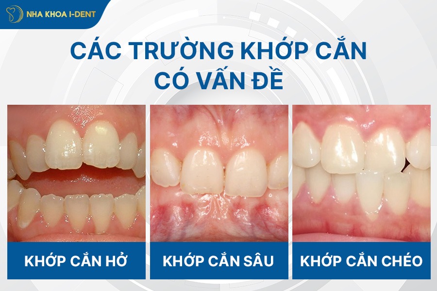khi nào cần niềng răng