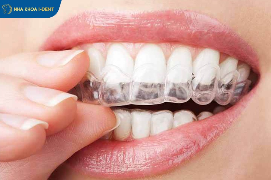 niềng răng bị hô hơn