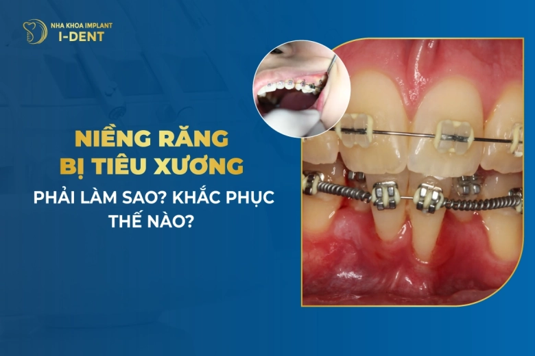 Niềng Răng Bị Tiêu Xương Phải Làm Sao? Khắc Phục Thế Nào?