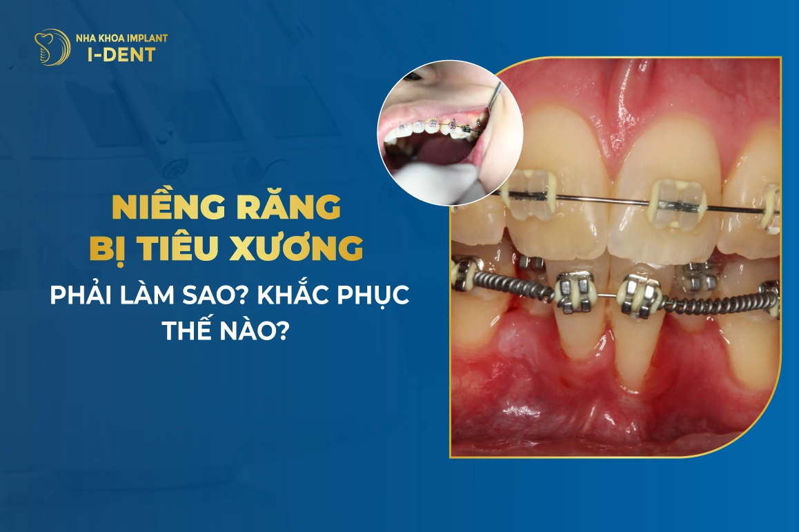 Niềng Răng Bị Tiêu Xương Phải Làm Sao? Khắc Phục Thế Nào?
