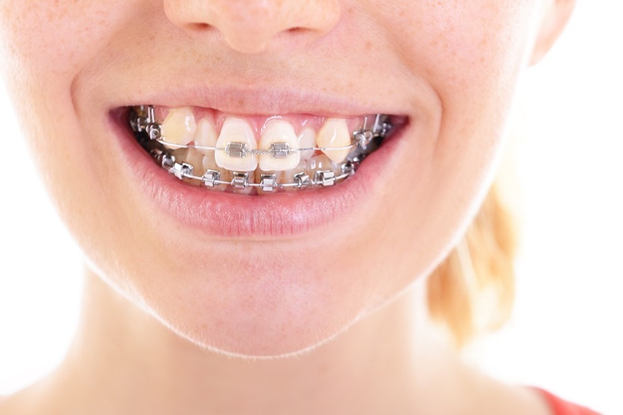 Niềng răng khểnh