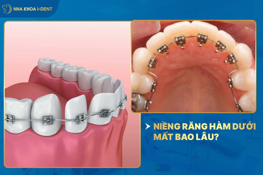 niềng răng dưới