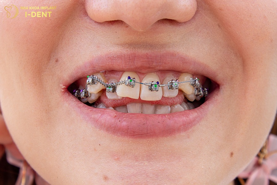 niềng răng có phải nhổ răng khểnh không