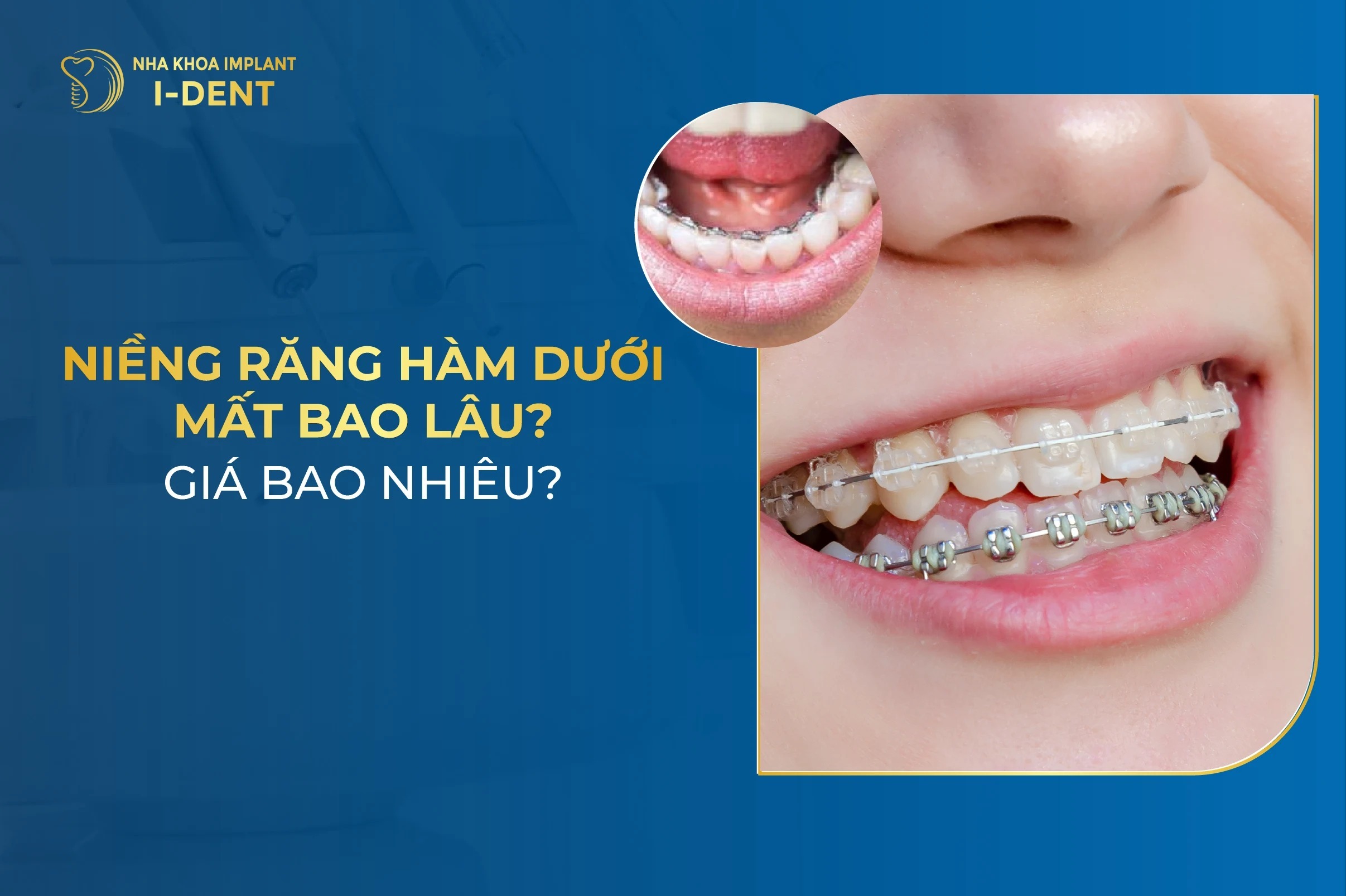 Niềng Răng Hàm Dưới Mất Bao Lâu? Giá Bao Nhiêu?