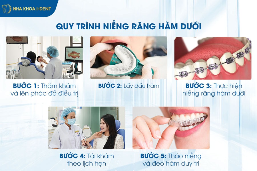 niềng răng hàm dưới mất bao lâu