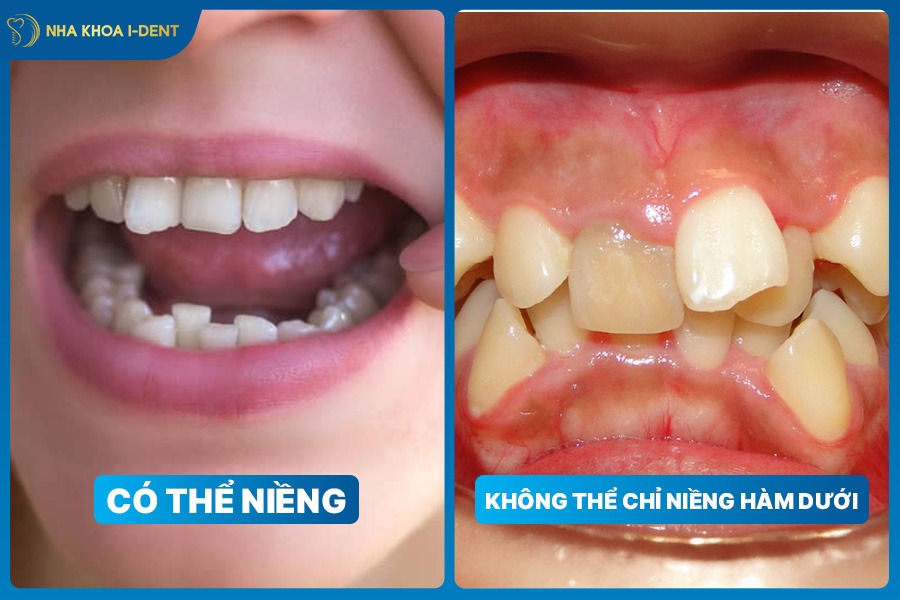 niềng răng hàm dưới