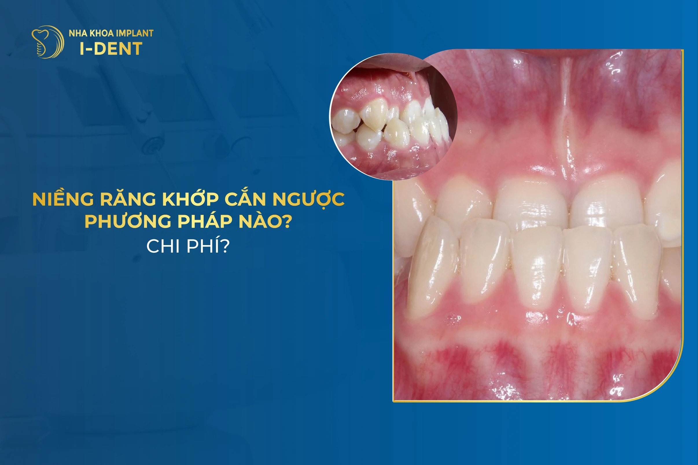 Niềng Răng Khớp Cắn Ngược Phương Pháp Nào? Chi Phí?