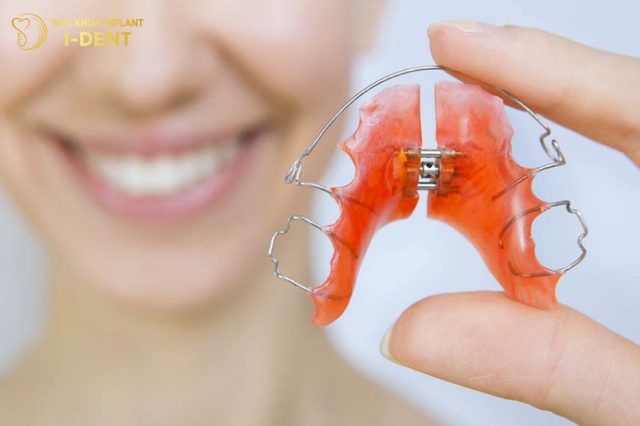 niềng răng tháo lắp là gì