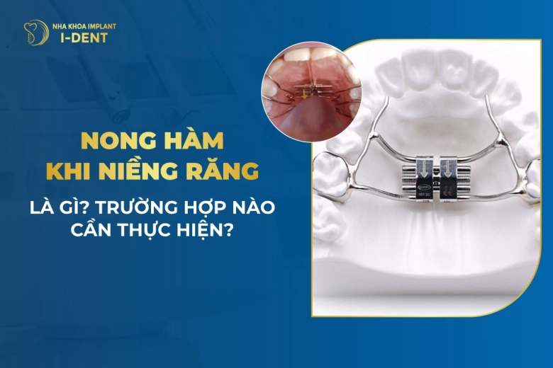 Nong Hàm Khi Niềng Răng Là Gì? Trường Hợp Nào Cần Thực Hiện?