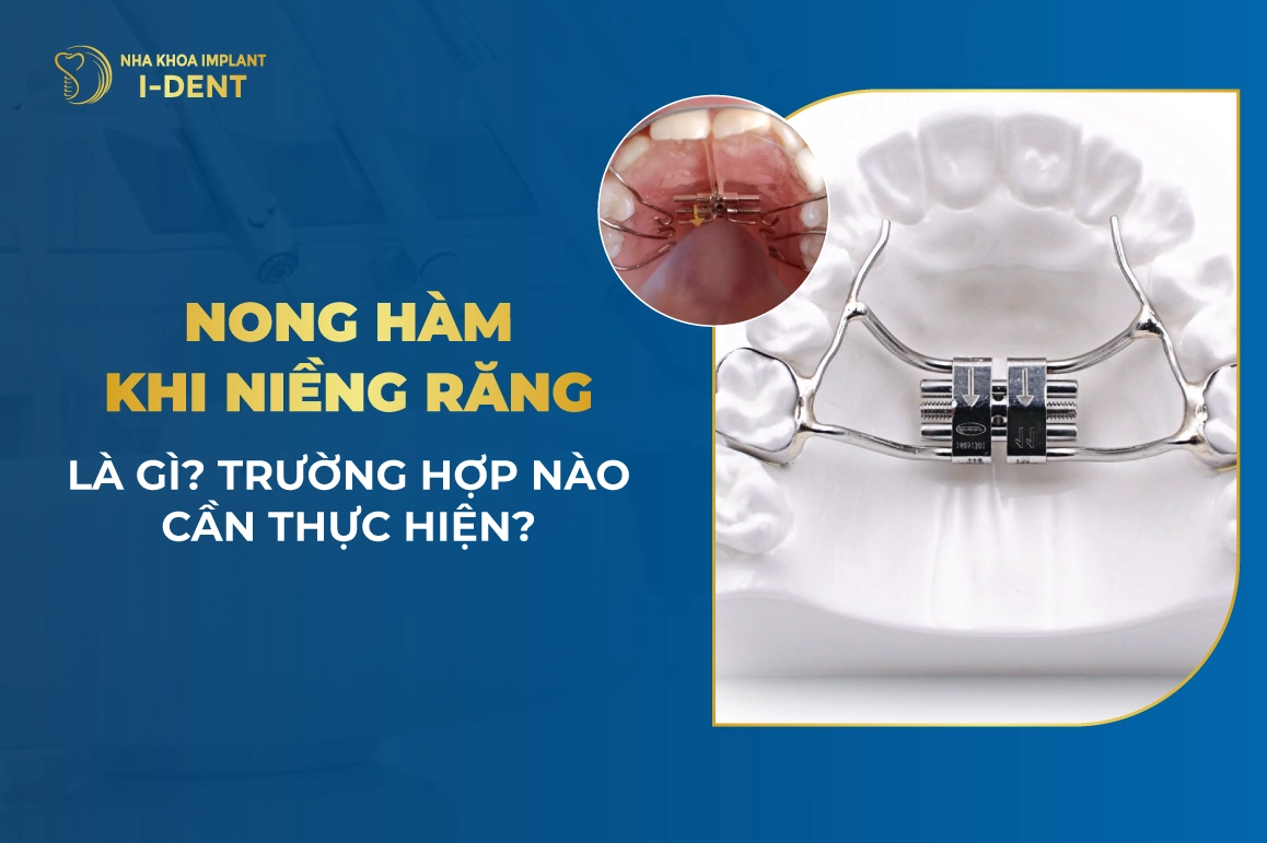 Nong Hàm Khi Niềng Răng Là Gì? Trường Hợp Nào Cần Thực Hiện?