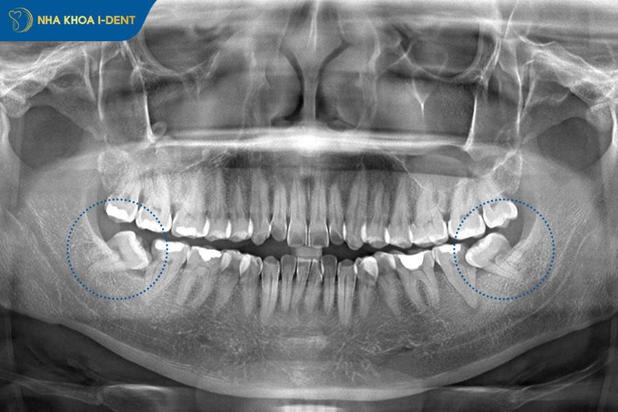 răng bị chạy sau khi niềng