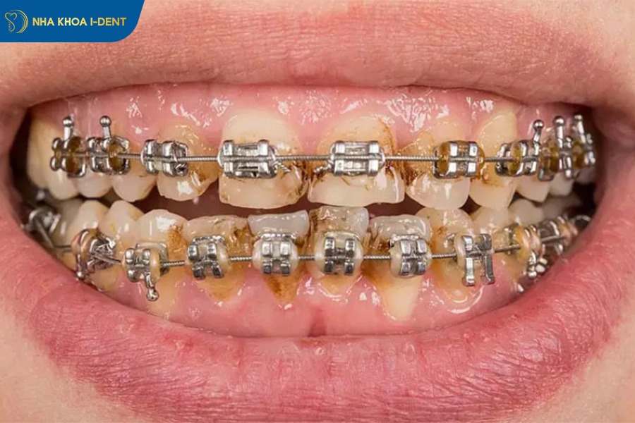 răng hô sau khi niềng