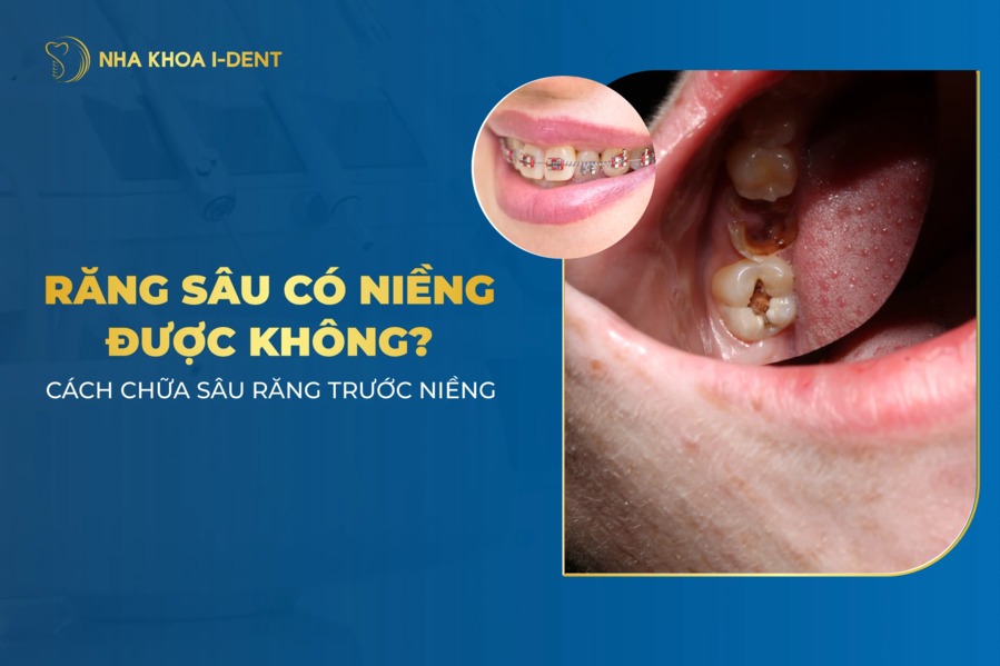 Đang Bị Sâu Răng Có Niềng Được Không?