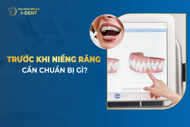 TOP 10 Những Lưu Ý Khi Niềng Răng Cần Biết