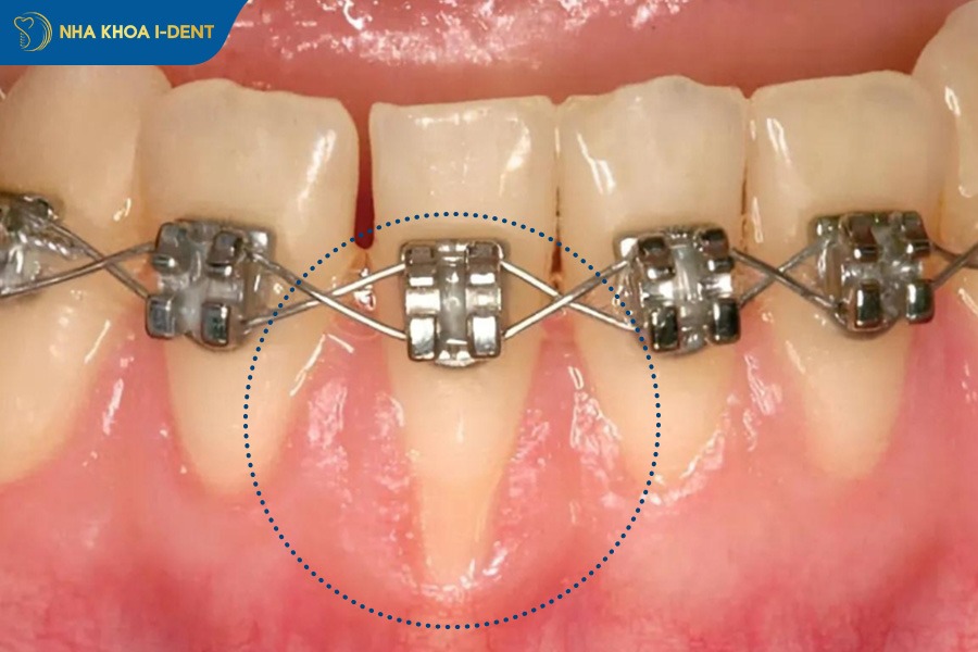 tụt lợi khi niềng răng