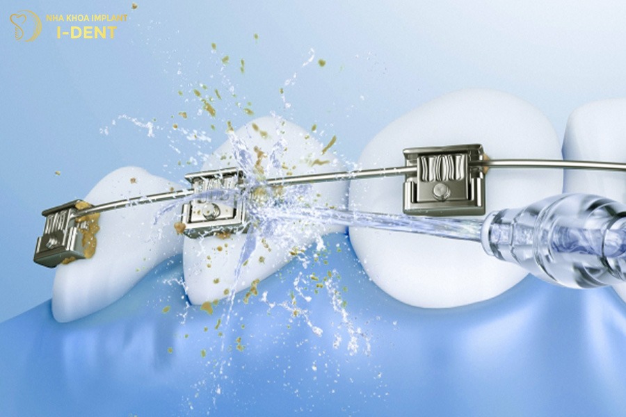 niềng răng khấp khểnh