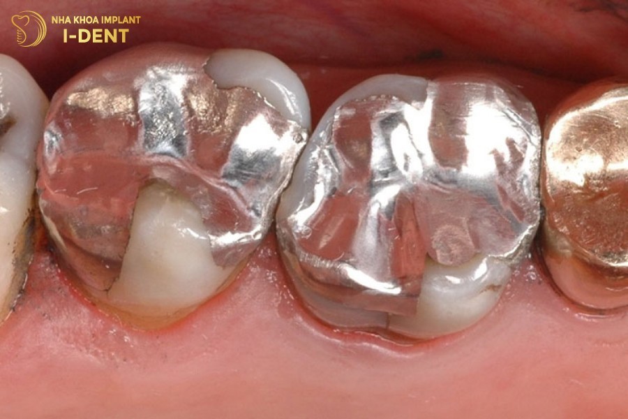 Amalgam-la-vat-lieu-tram-rang-co-chua-thuy-ngan