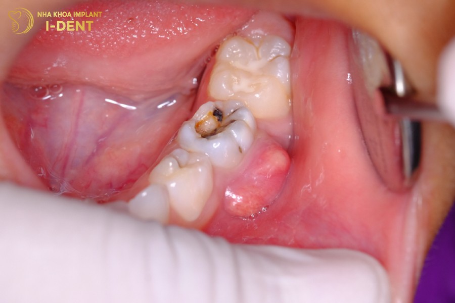 Ap-xe-co-mu-la-bien-chung-nguy-hiem-khi-tuy-rang-bi-thoi