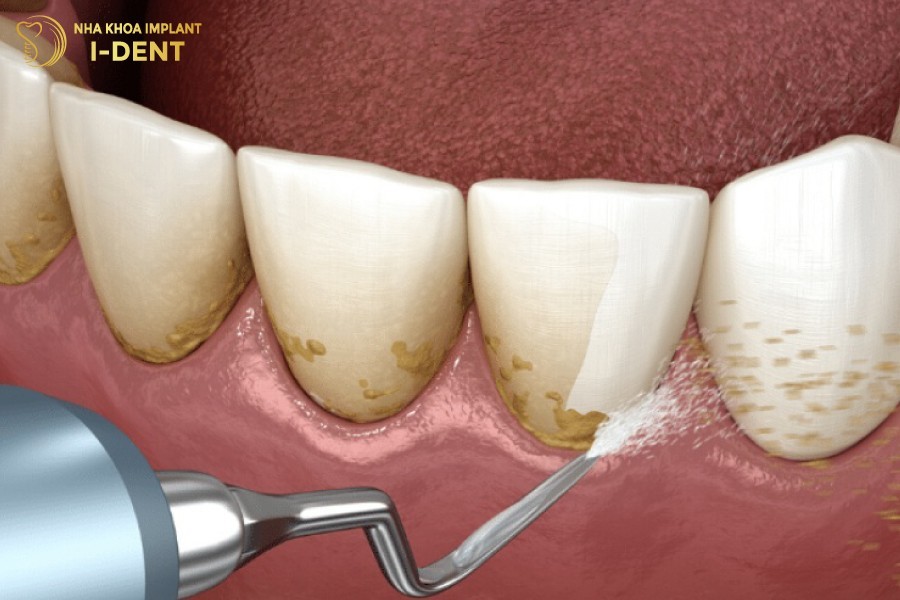 Bac-si-co-the-cao-voi-rang-de-lam-sach-rang-mieng