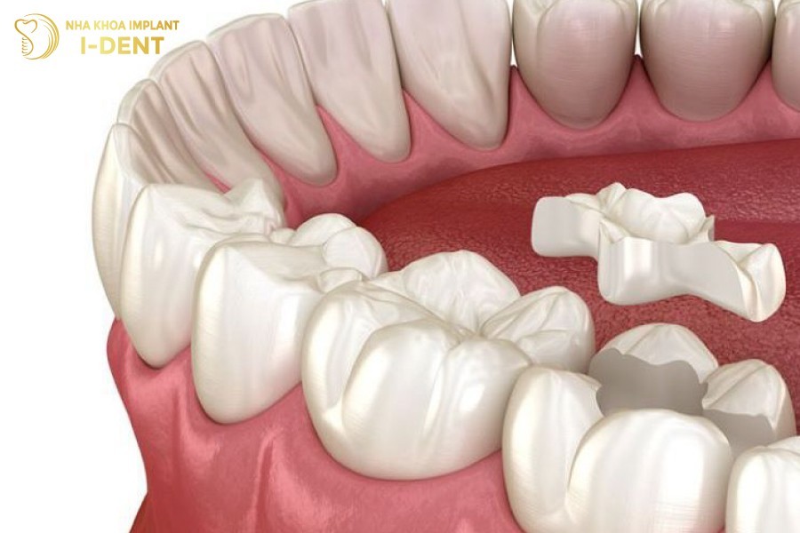 Bac-si-danh-bong-mieng-tram-de-tao-su-mem-mai-tuong-thich-cho-rang