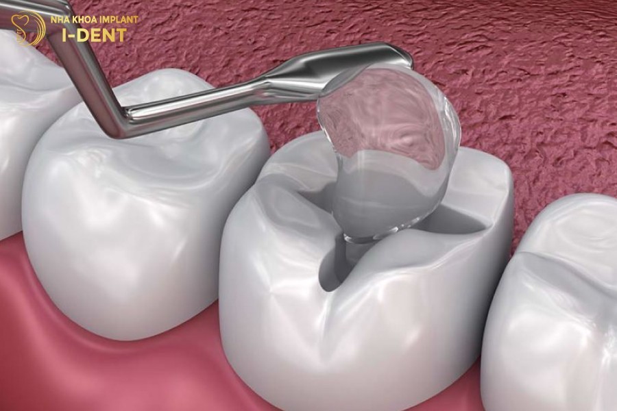 Bac-si-tien-hanh-tram-bo-sung-voi-mieng-tram-rang-bi-vo-it