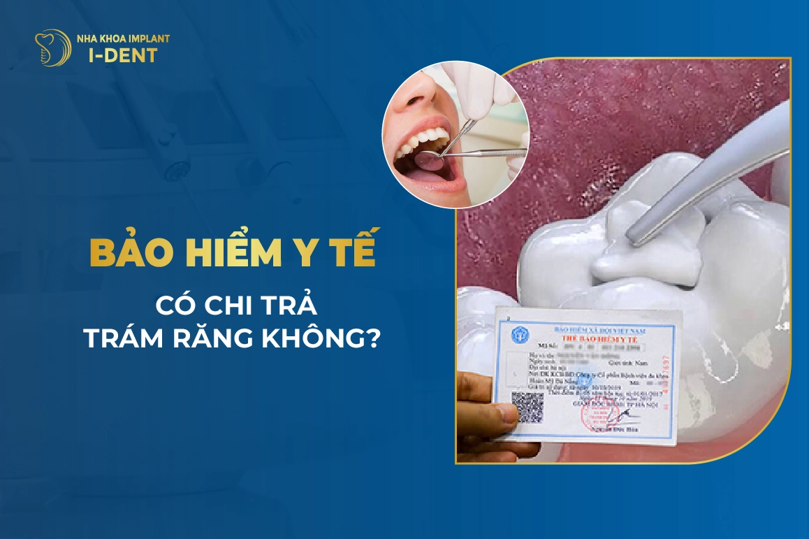 Bảo Hiểm Y Tế Có Chi Trả Trám Răng Không?