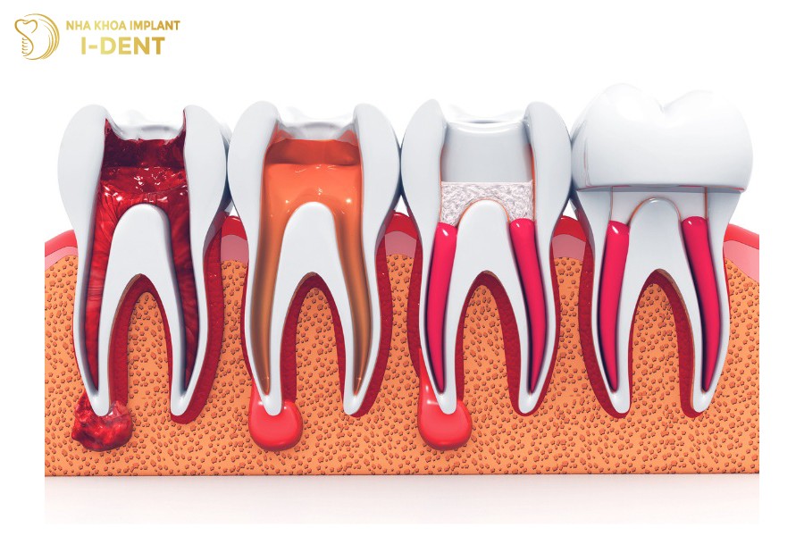 Boc-rang-su-giup-bao-ve-tot-rang-that-trong-truong-hop-da-lay-het-tuy