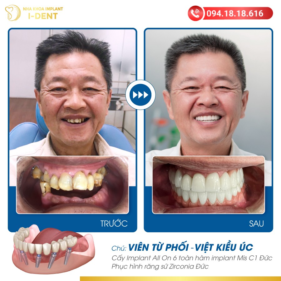 CHÚ VIÊN TỬ PHỐI