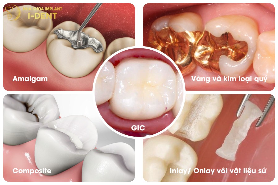 Cac-vat-lieu-tram-rang-pho-bien-hien-nay