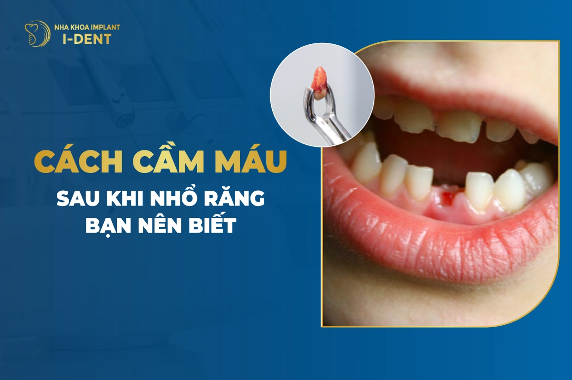 Cách cầm máu sau khi nhổ răng hiệu quả và lành thương nhanh