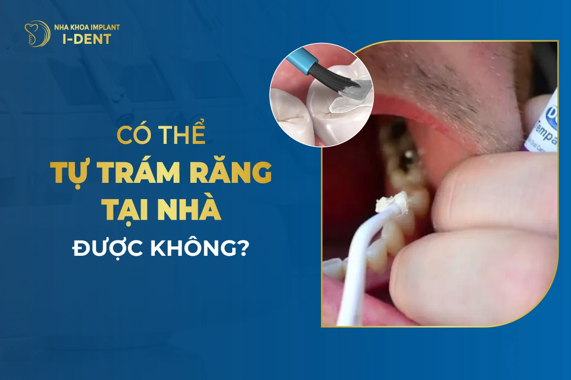 Có Thể Tự Trám Răng Tại Nhà Được Không?