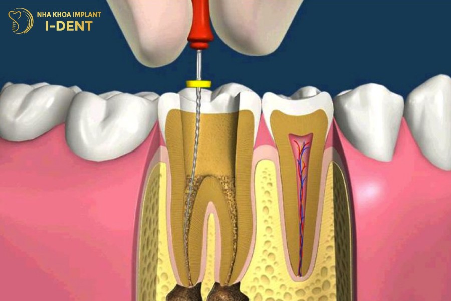 Gia-chua-tuy-rang-so-6-se-cao-hon-rang-cua-rang-tien-ham