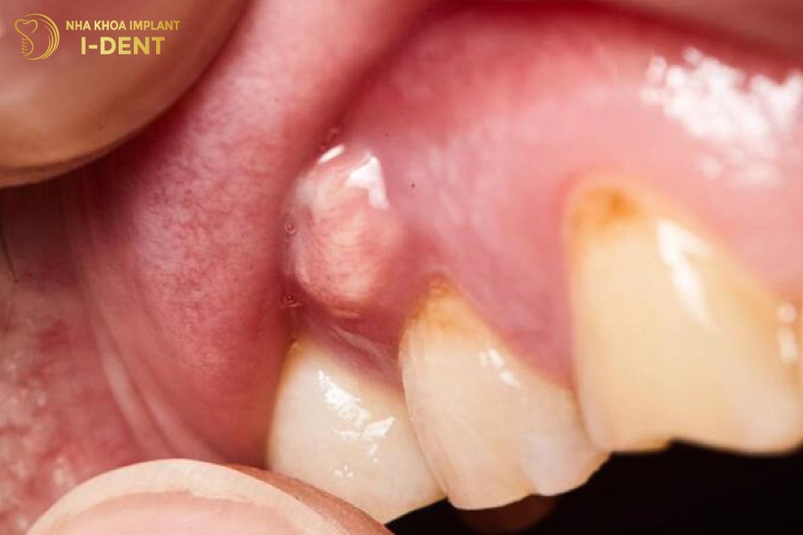 Khi-thay-co-o-mu-trang-xuat-hien-duoi-chan-rang-ban-can-den-gap-bac-si-ngay