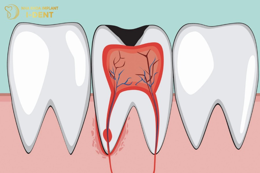 Khi-tuy-rang-bi-viem-dau-nhuc-thi-can-phai-dieu-tri-tuy