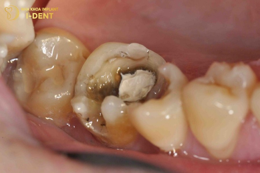 Lo-sau-rang-lon-tren-be-mat-rang