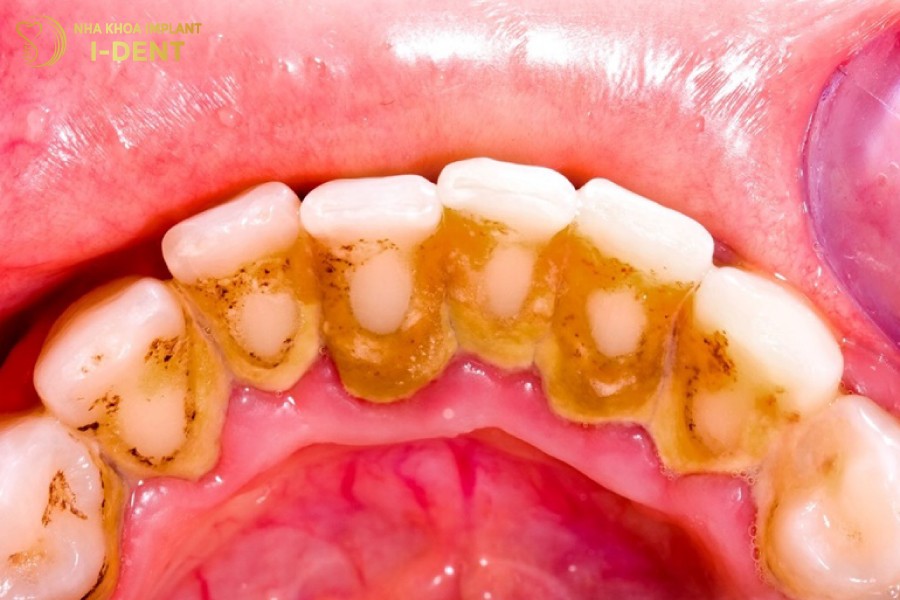 Mang-bam-voi-rang-la-nguyen-nhan-hang-dau-gay-viem-tuy-rang