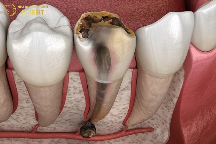 Mau-rang-chuyen-xam-den-khi-tuy-bi-ton-thuong-nang