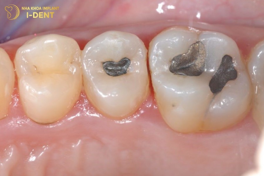 Mieng-tram-kenh-com-gay-dat-thuc-an-va-dan-toi-sau-rang