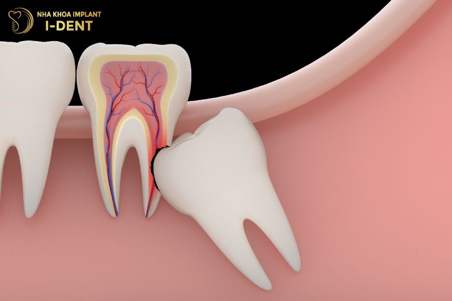 Moc-rang-khon-co-the-pha-huy-cau-truc-rang-so-7-khien-rang-bi-viem-tuy