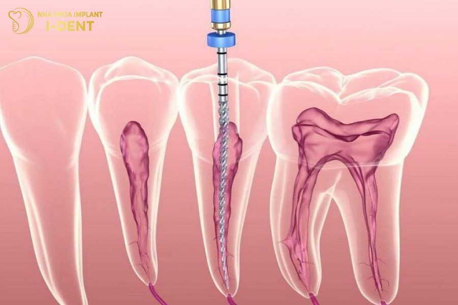Neu-phai-chua-tuy-thi-thoi-gian-tram-rang-se-keo-dai-trong-vai-lan-hen