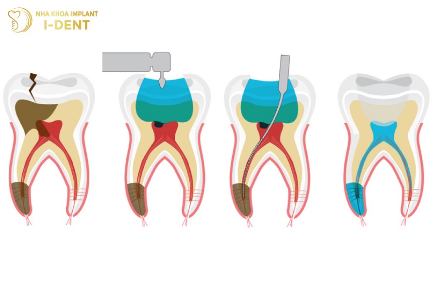 Qua-trinh-lay-tuy-doi-hoi-bac-si-phai-thuc-hien-ti-mi-can-than