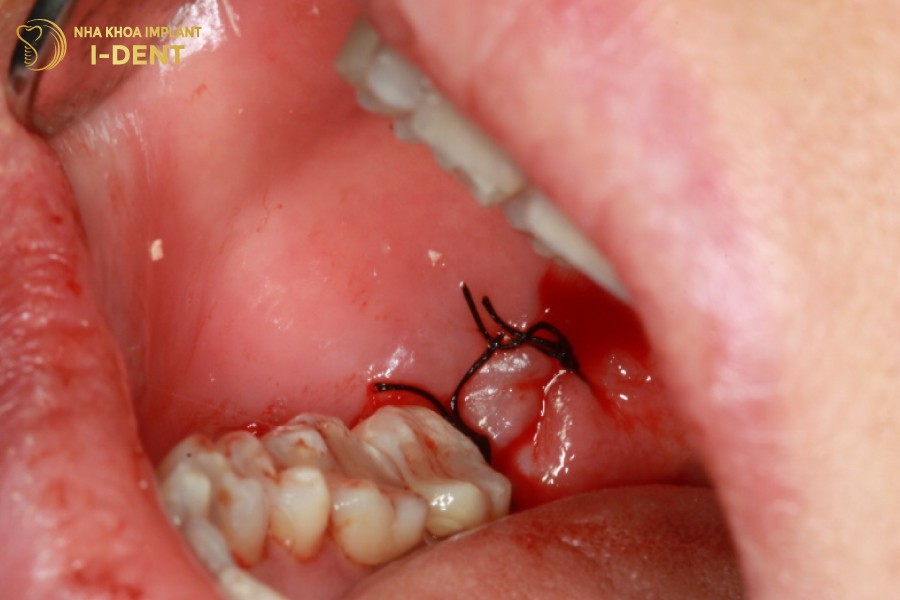 Qua-trinh-phuc-hoi-sau-khi-nho-rang